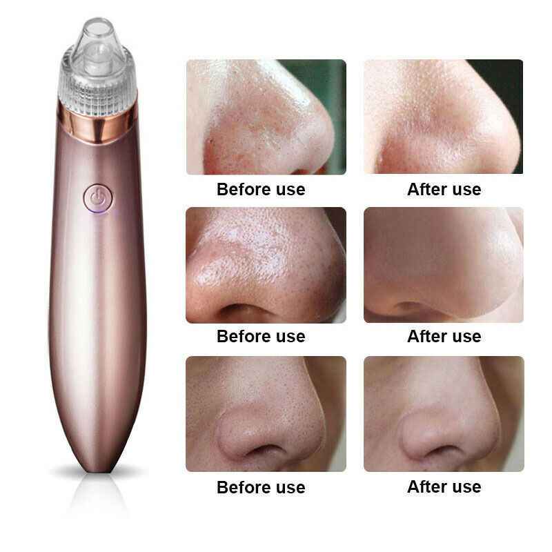 Electric Blackhead Vacuum Pore Cleaner Tool