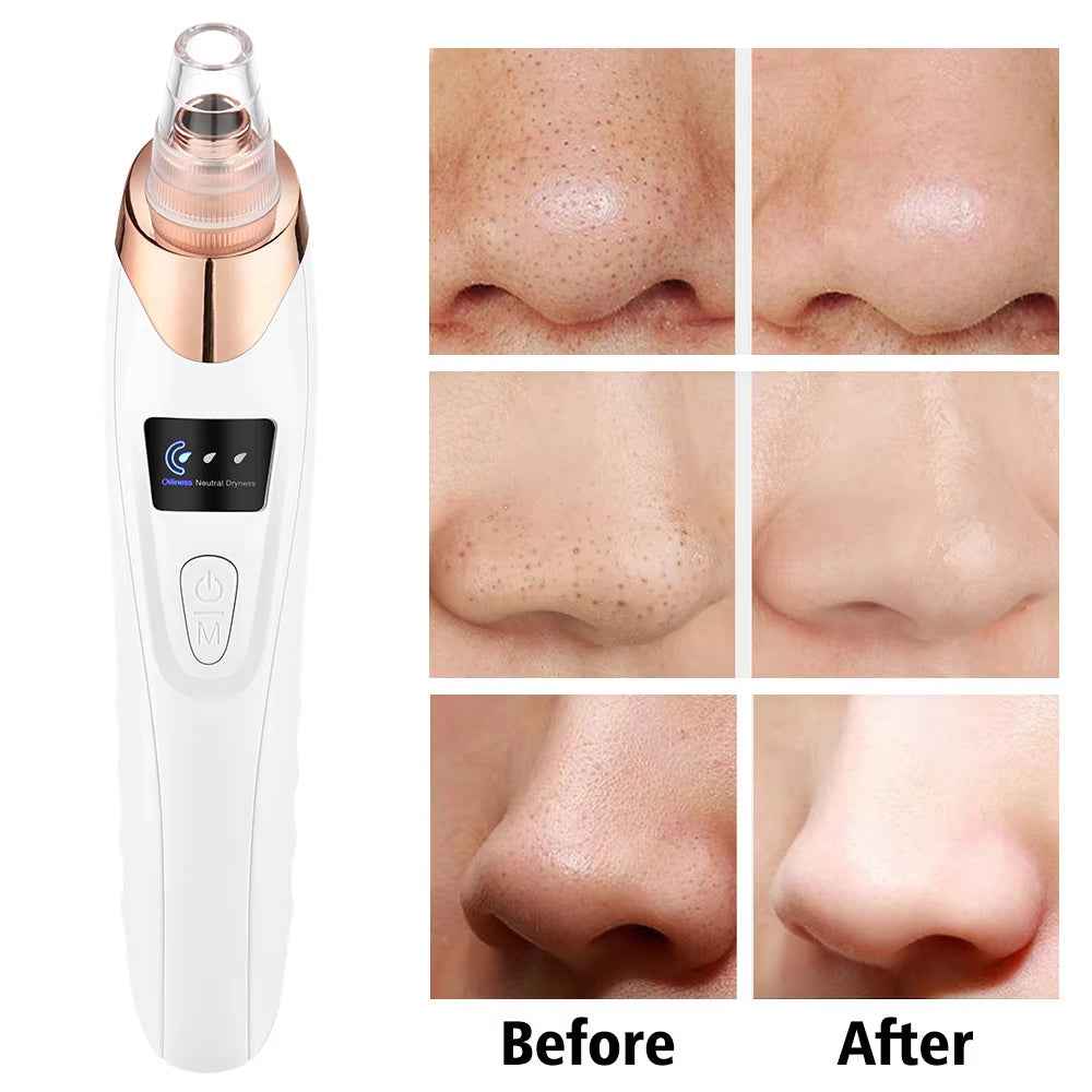PurePore Pro – Electric Vacuum Blackhead Remover & Facial Cleansing Tool Kit