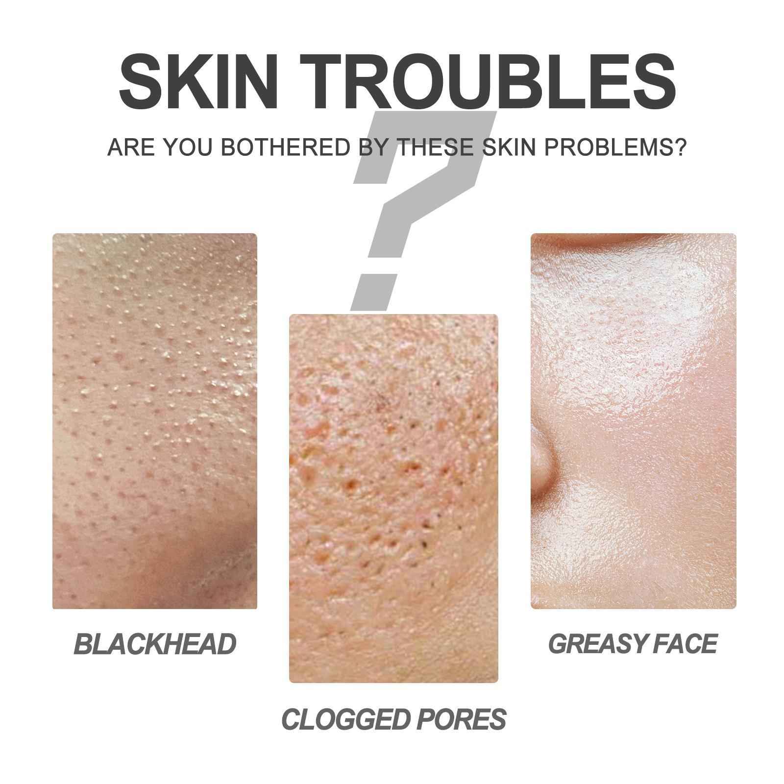 Blackhead Cleansing Cream – Exfoliating & Pore-Refining Nose Patch