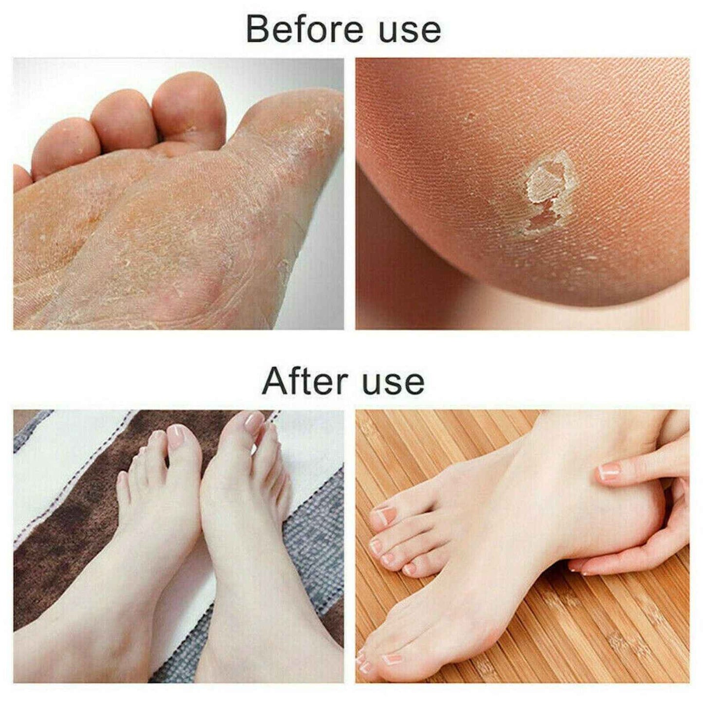 LUPO™ Stainless Steel Foot Scraper Callus Remover
