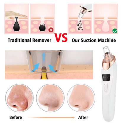 PurePore Pro – Electric Vacuum Blackhead Remover & Facial Cleansing Tool Kit