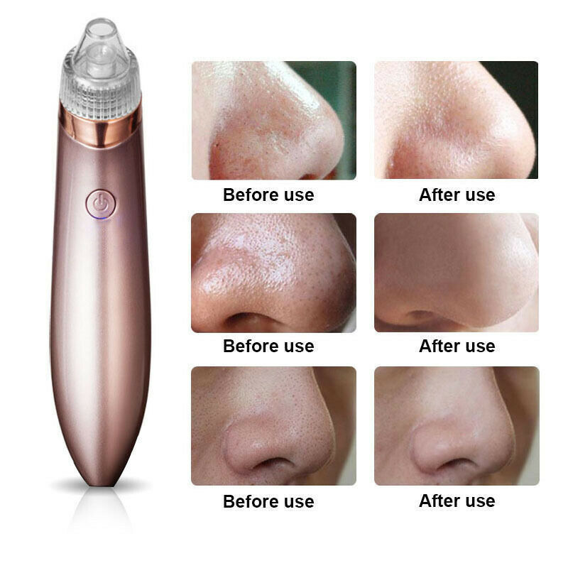 Electric Blackhead Vacuum Pore Cleaner – Deep Facial Cleansing & Skin Rejuvenation Tool