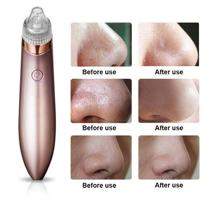 Electric Blackhead Vacuum Pore Cleaner – Deep Facial Cleansing & Skin Rejuvenation Tool